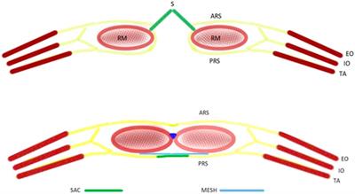 Hernia Sac Preservation for Prevention of Transversus Abdominis Release in Laparoscopic Extended-Totally Extra Peritoneal Repair of Ventral Hernia: A Minimalistic Solution for a Formidable Challenge